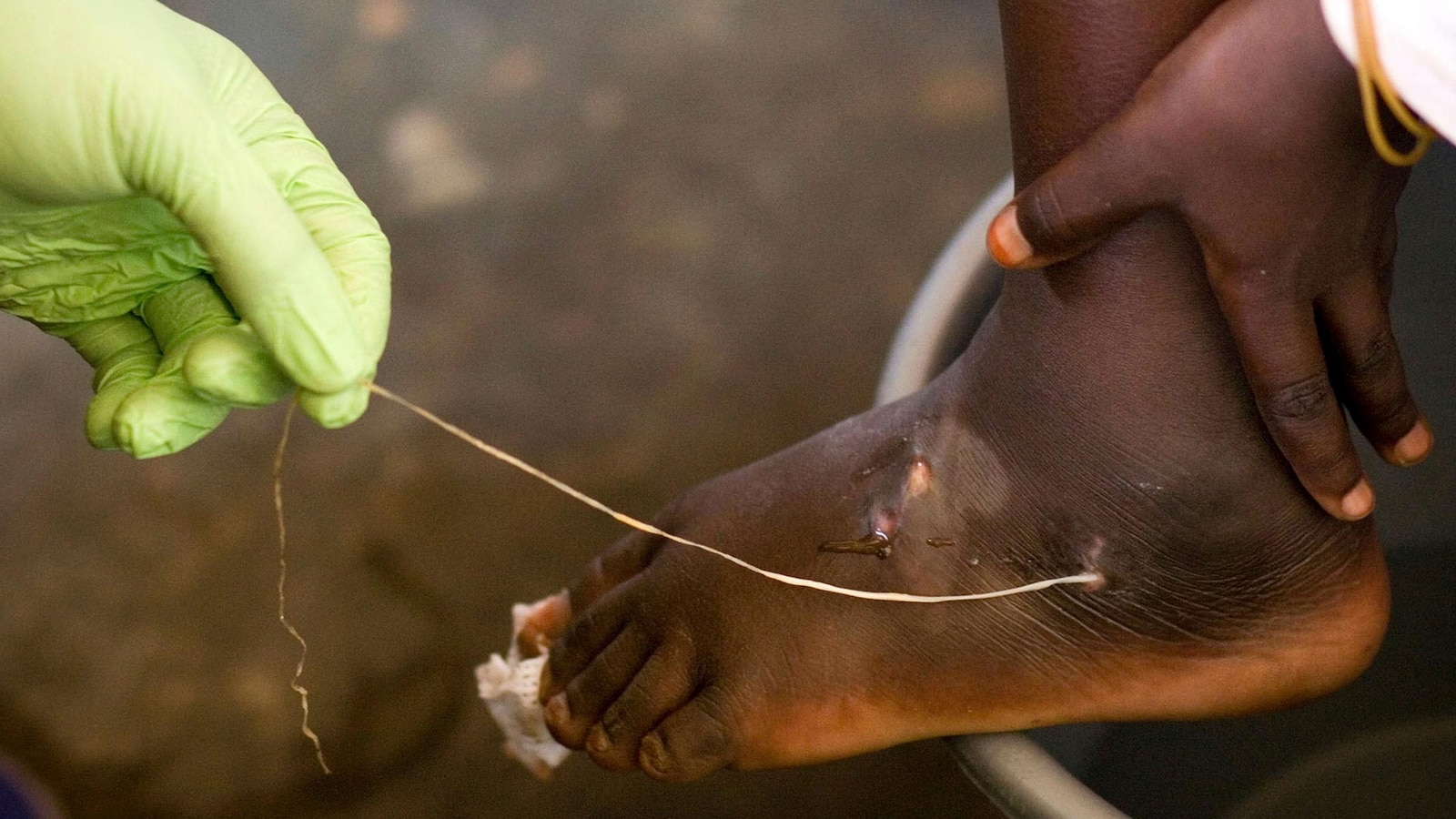 World creeps closer to eradicating human Guinea worm cases, with just 10 last year: Carter Center