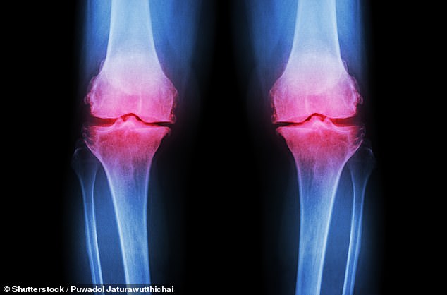 Women are at higher risk of osteoporosis due to rapid bone loss after the first few years of the menopause