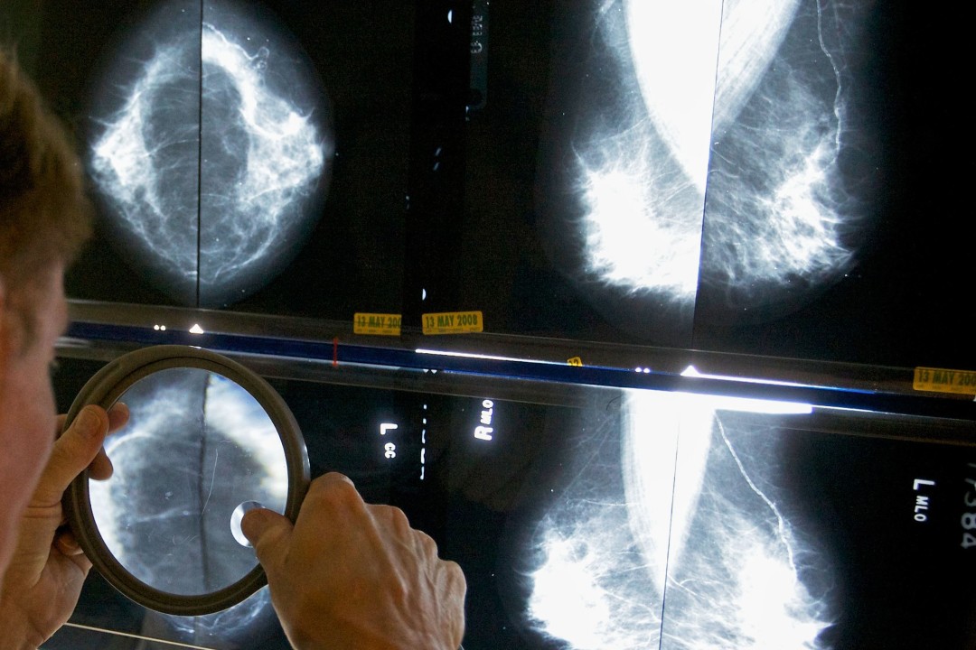 Cancer Patients Suffered a Pandemic Double Whammy