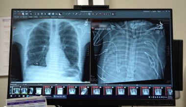 Patient survives 48 hours after surgeons remove both lungs at Northwestern