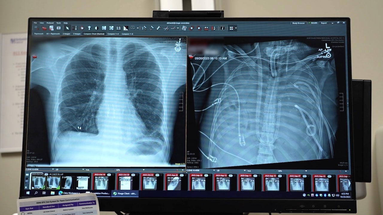Patient survives 48 hours after surgeons remove both lungs at Northwestern