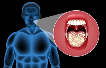 Oral cancer signs involve white/red tissue patches, mouth pain, and loose teeth. (Freepik)
