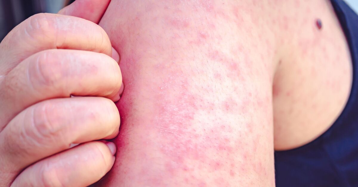 Victorian disease outbreak rocks major city sparking World Cup warning | World | News