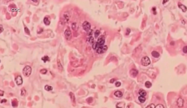 Over 50 cases of measles confirmed at Ave Maria University | Collier County