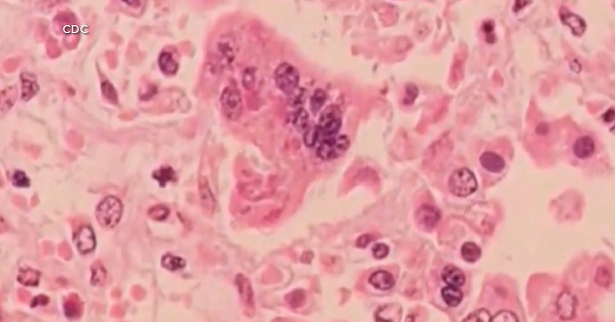 Over 50 cases of measles confirmed at Ave Maria University | Collier County