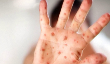 Measles exposure reported at Phoenix Sky Harbor International Airport