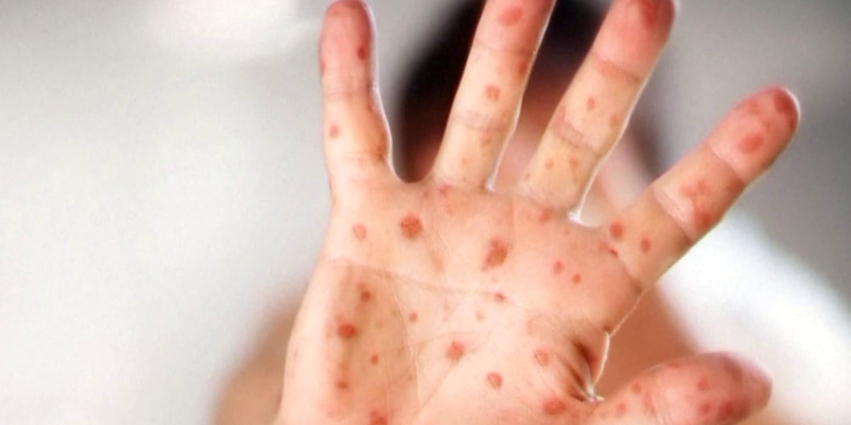 Measles exposure reported at Phoenix Sky Harbor International Airport