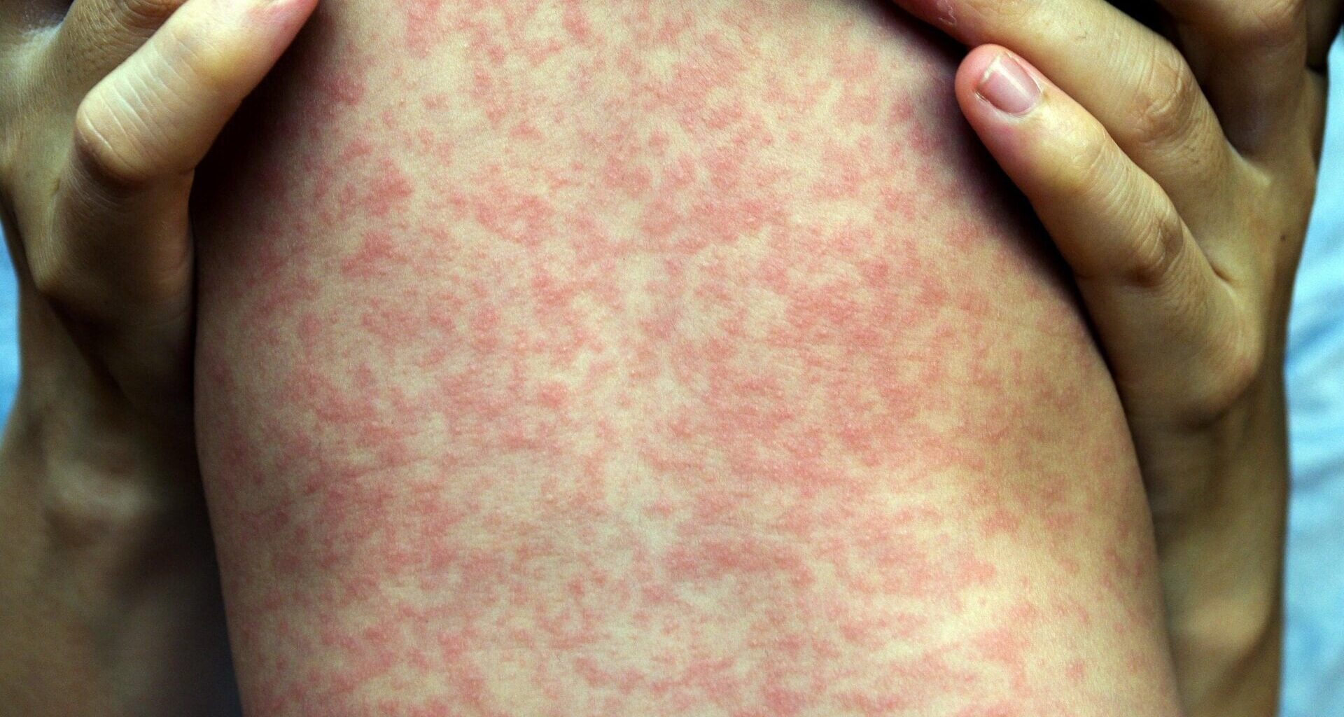A characteristic example of the rash caused by measles infection.