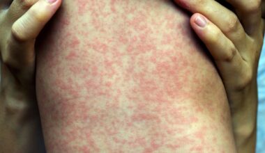 A characteristic example of the rash caused by measles infection.