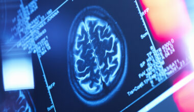 Hidden Patterns of Body Fat Could Be Shrinking Your Brain, Study Finds : ScienceAlert