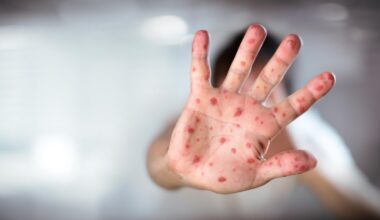 Health officials investigate new measles exposure at Madison hotel