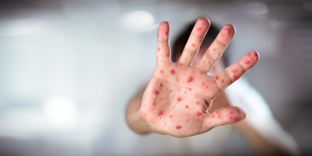 Health officials investigate new measles exposure at Madison hotel