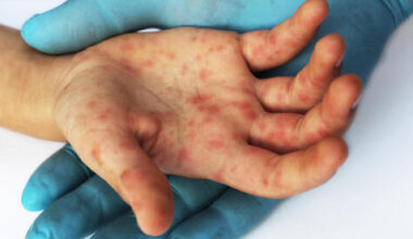 Unvaccinated children removed from Israeli kindergartens as measles outbreak worsens