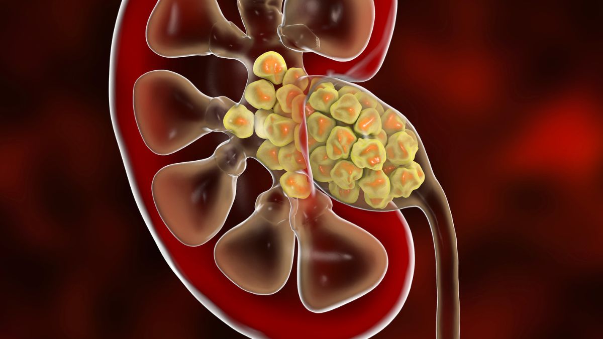 Surprising Find Inside Kidney Stones Suggests We Were Wrong About How They Form : ScienceAlert