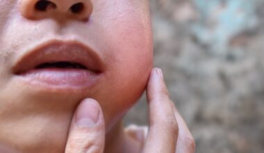 Mumps cases are soaring in Maryland