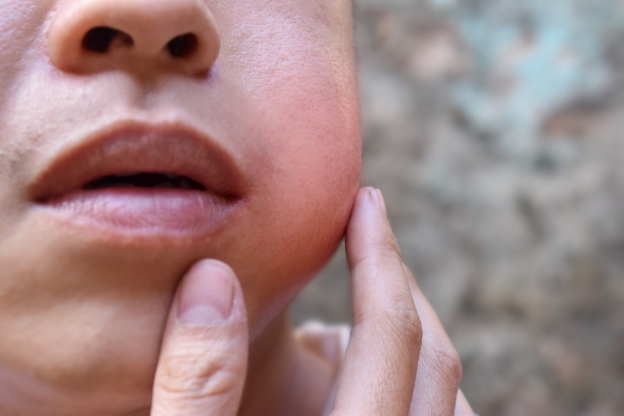 Mumps cases are soaring in Maryland