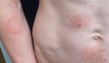 Nation's 'largest known outbreak' of sexually transmitted ringworm fungus in Minnesota