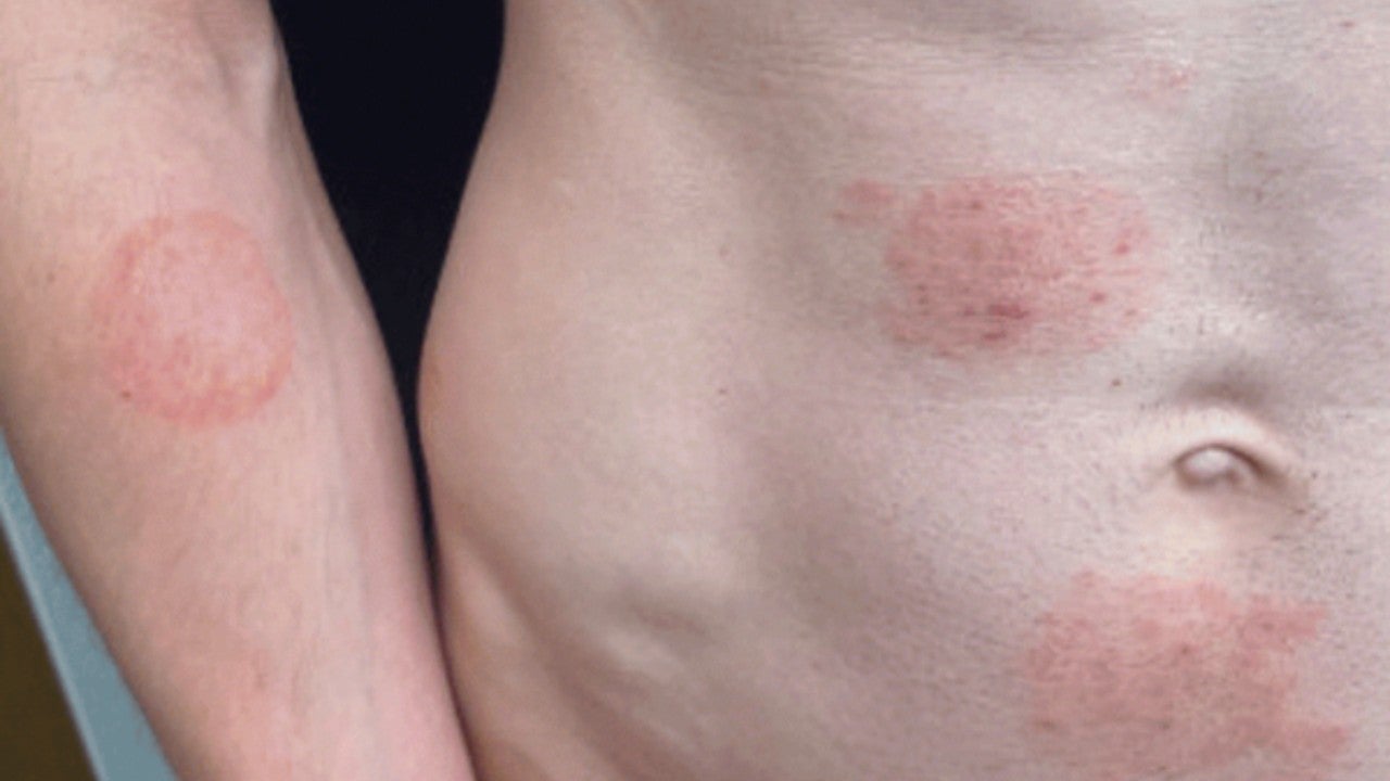 Nation's 'largest known outbreak' of sexually transmitted ringworm fungus in Minnesota