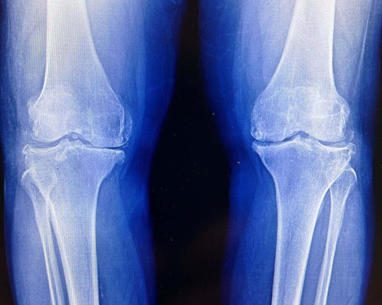 Scientists Found a Way to Regrow Cartilage Without Using Stem Cells