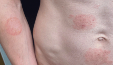 A sexually transmitted ringworm is spreading in one US state