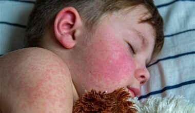 Seeing red: U.S. measles elimination status at risk as contagious virus continues to spread