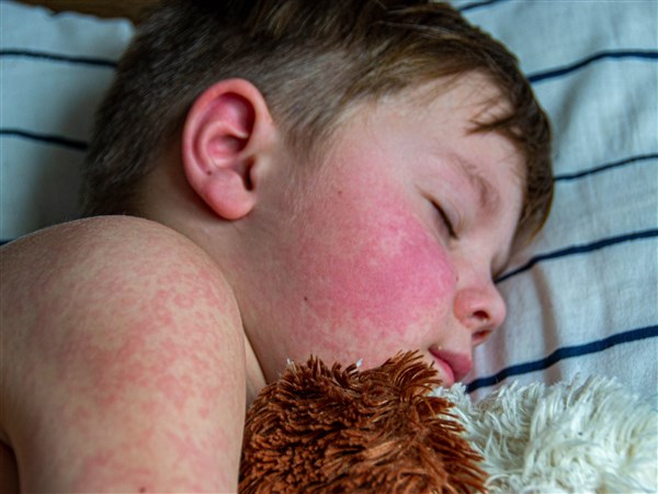 Seeing red: U.S. measles elimination status at risk as contagious virus continues to spread