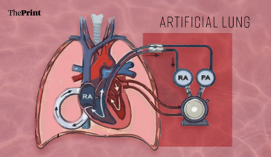 A US man lived two days without lungs. Why it can revolutionise transplant practice