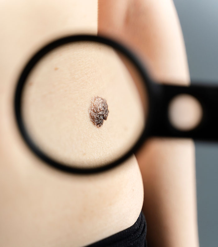 Close-up of a skin lesion being examined with a magnifying glass, part of weirdly hilarious images collection.