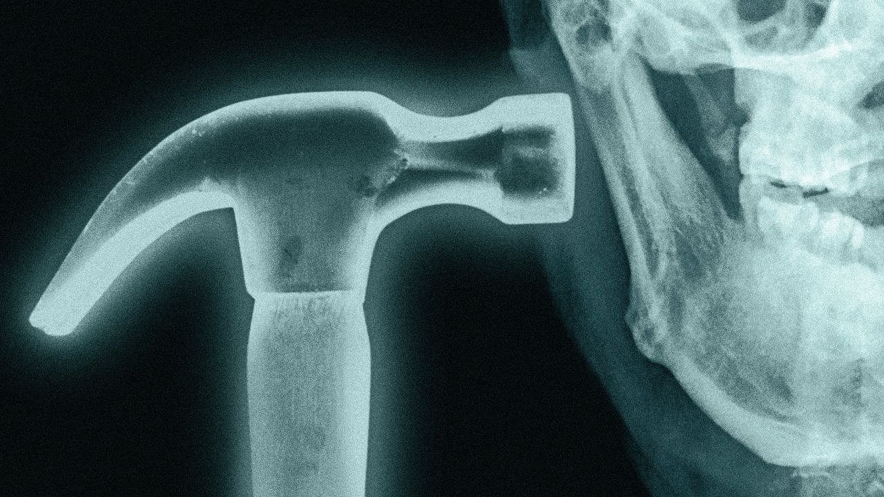 What is Bonesmashing? Inside the Extreme Looksmaxxer Technique