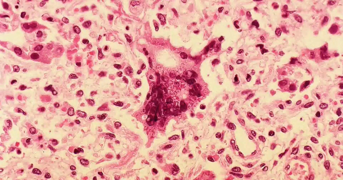 Person with measles visited car dealership and Wawa in Montgomery County, Pennsylvania health officials say