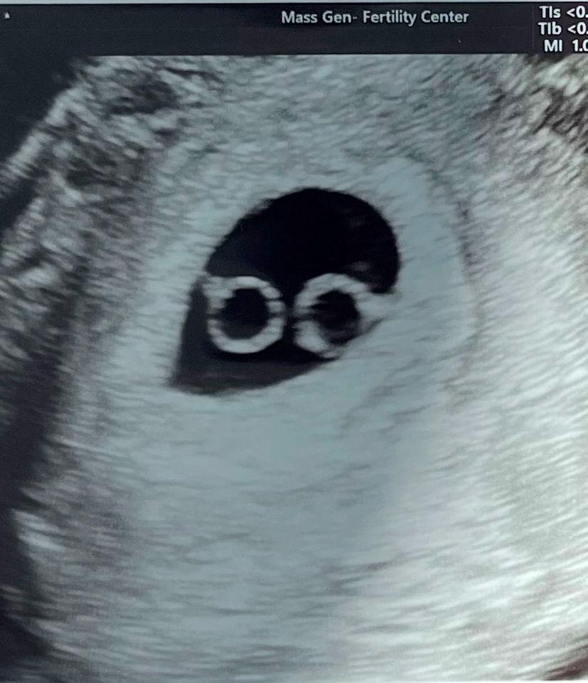 Abby Wood's ultrasound Courtesy of Abby Wood