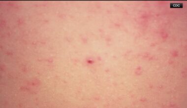 Unvaccinated Georgia resident diagnosed with measles | What we know