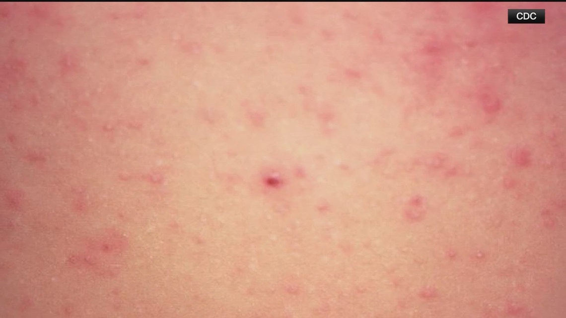 Unvaccinated Georgia resident diagnosed with measles | What we know