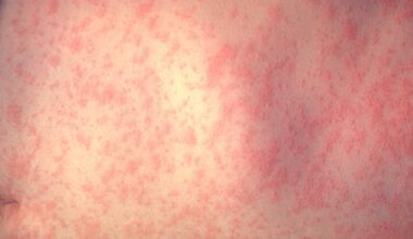 Measles case reported in Georgia – WSB-TV Channel 2