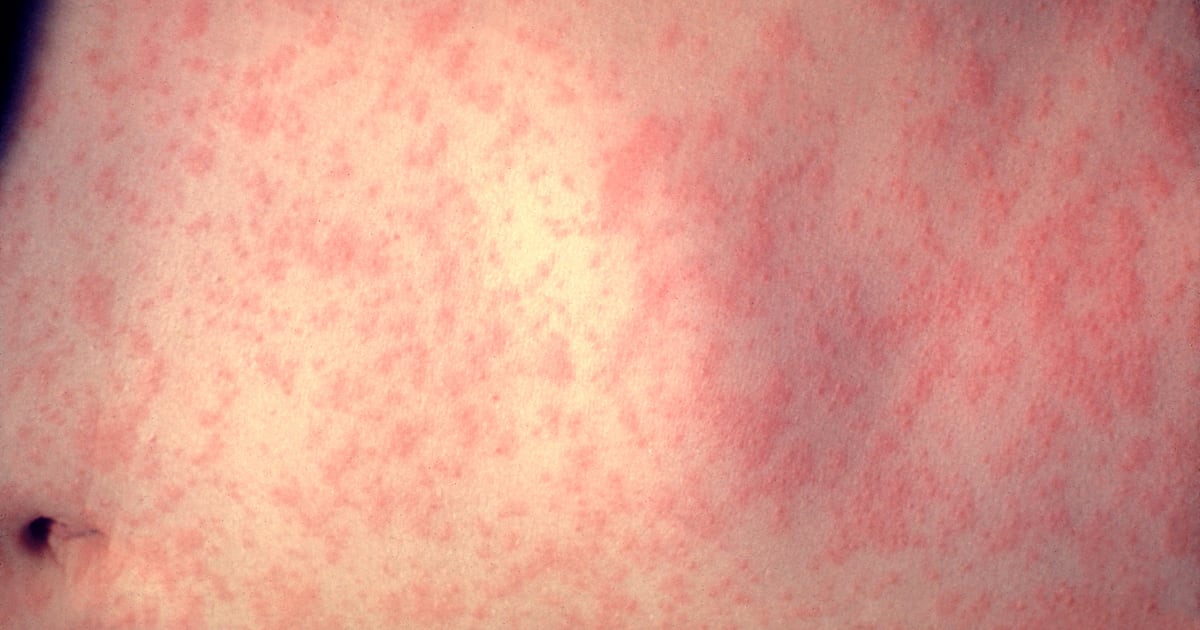 Measles case reported in Georgia – WSB-TV Channel 2