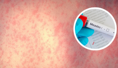 Massachusetts health officials announce confirmed measles cases in child, adult – Boston 25 News