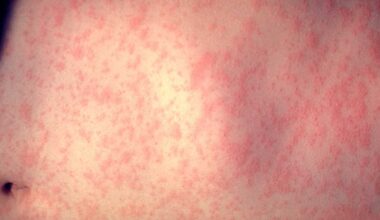 Health officials confirm 2 measles cases linked to Massachusetts