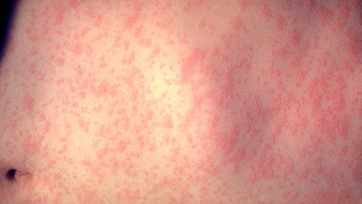 Health officials confirm 2 measles cases linked to Massachusetts