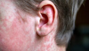 CDC Refuses to Take Blame for Measles Spiraling out of Control