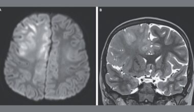 This Is What a Brain Destroyed by Measles Looks Like