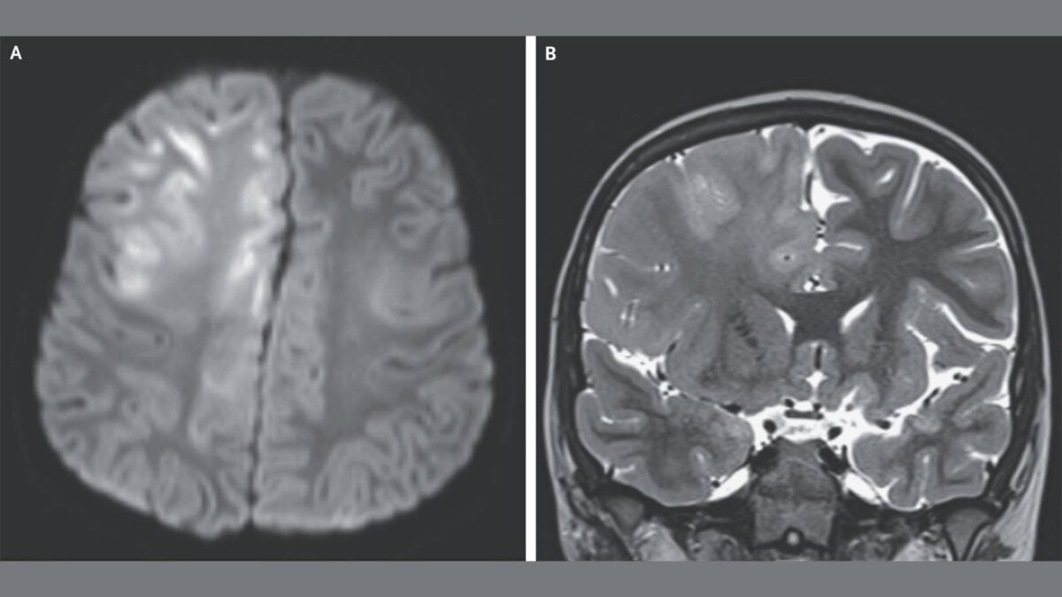 This Is What a Brain Destroyed by Measles Looks Like