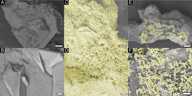 Bacterial Kidney Stones