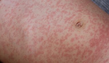 Measles Case Confirmed In Fairfax County, Marking 5th Case Of 2026