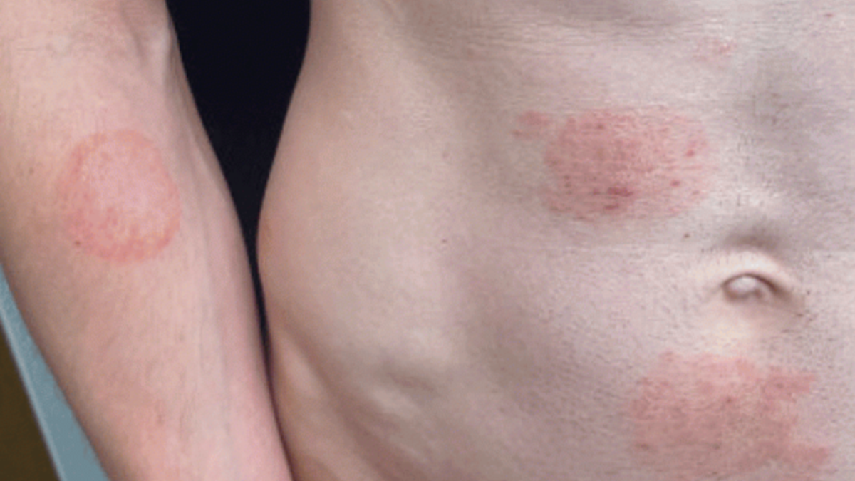 Infection is caused by Trichophyton mentagrophytes type VII (TMVII), a fungus that causes ringworm