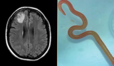 (left) Magnetic resonance image of patient&rsquo;s brain by fluid-attenuated inversion recovery demonstrating an enhancing right frontal lobe lesion, 13 0d7 10 mm. (right) Live third-stage larval form of O. robertsi (80 mm long, 1 mm diameter) under stereomicroscope (original magnification 0d710).
