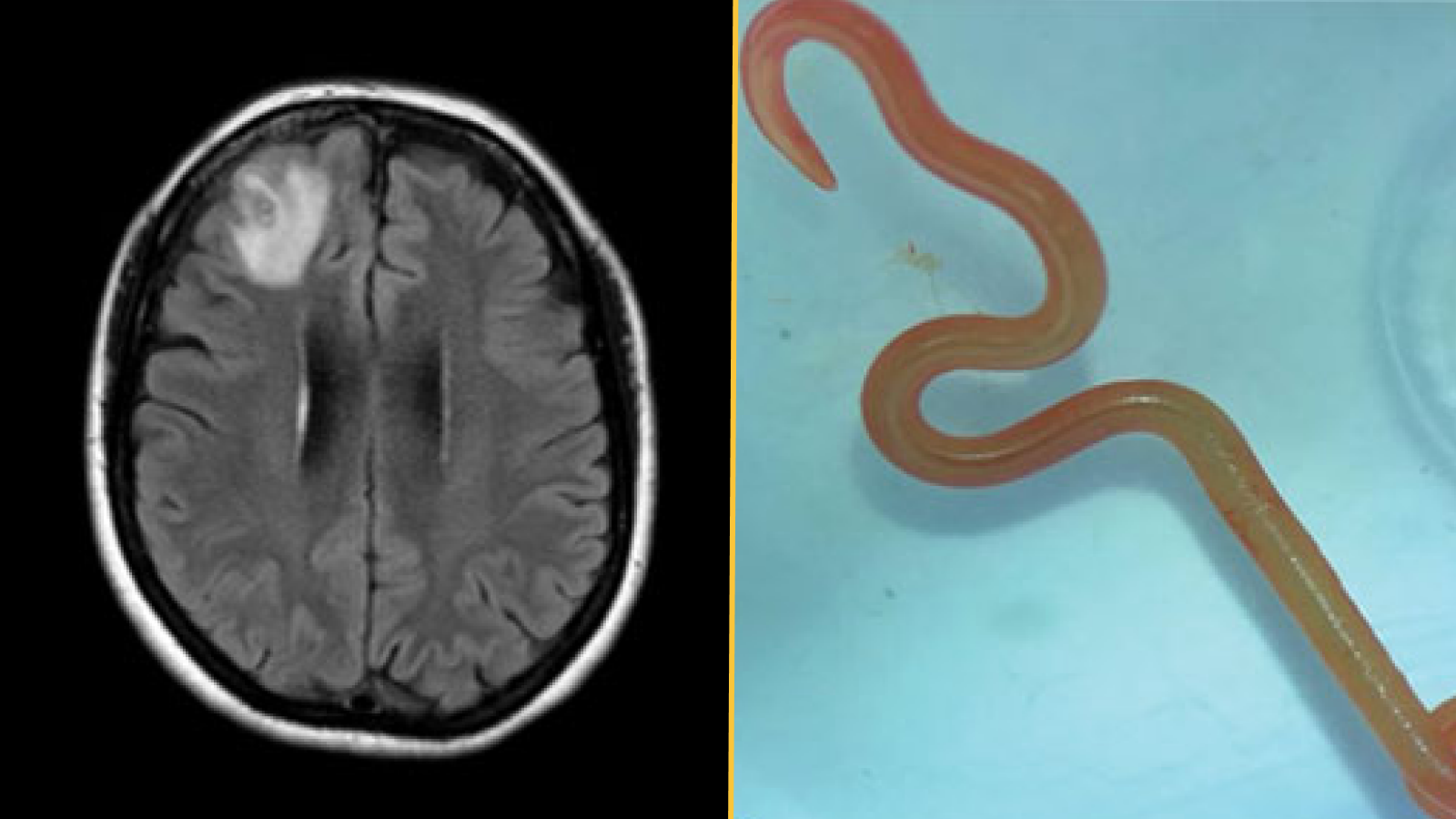 (left) Magnetic resonance image of patient&rsquo;s brain by fluid-attenuated inversion recovery demonstrating an enhancing right frontal lobe lesion, 13 0d7 10 mm. (right) Live third-stage larval form of O. robertsi (80 mm long, 1 mm diameter) under stereomicroscope (original magnification 0d710).