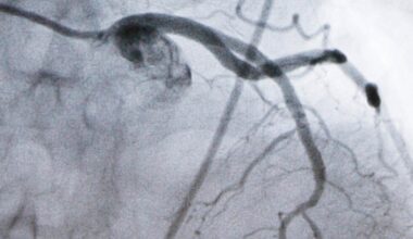 Merck's experimental pill enlicitide sharply lowered cholesterol in a large study