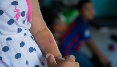 Kauai chickenpox outbreak doubles, expands to more schools