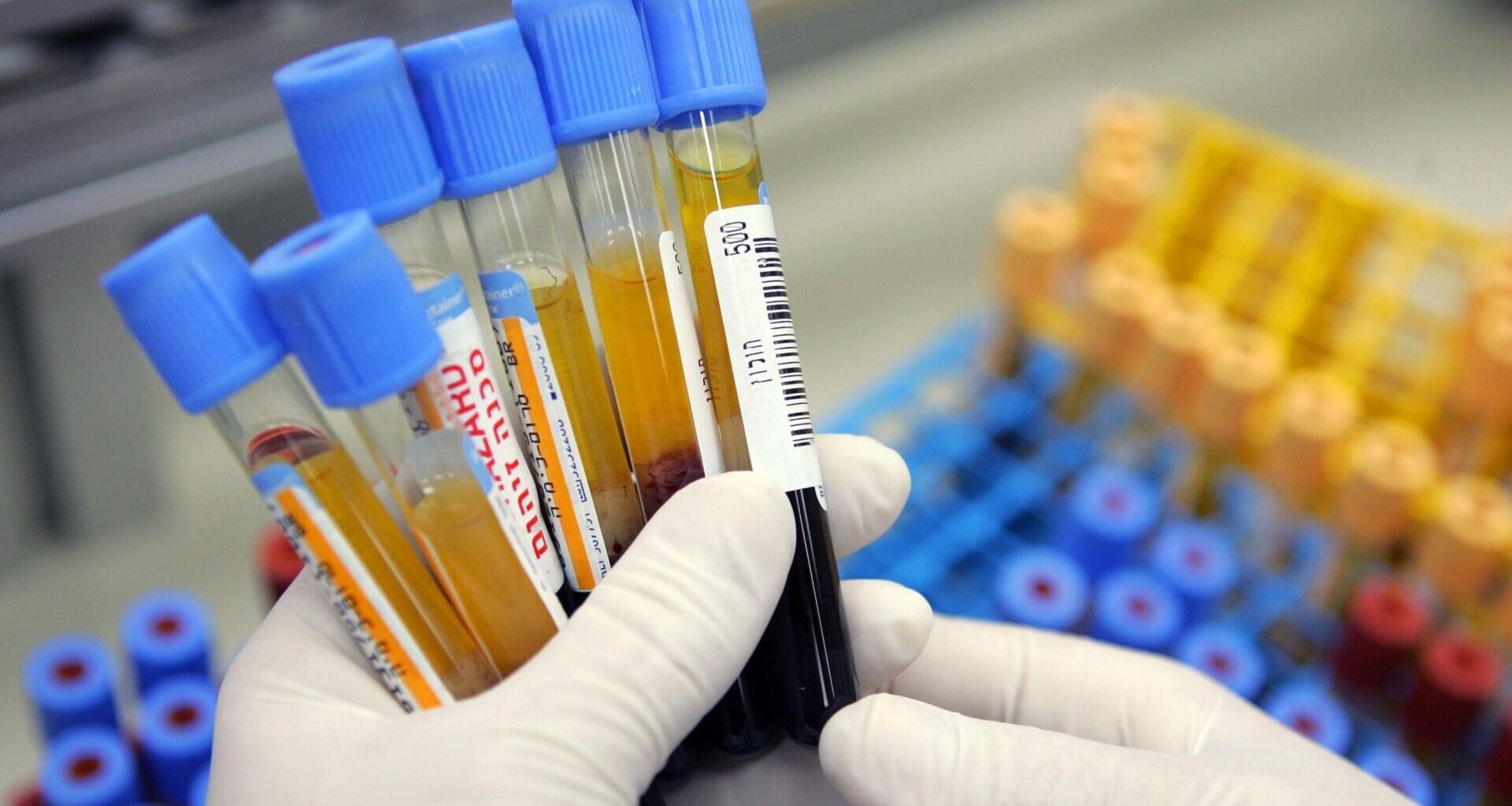 Our blood can contain proteins that hint at our likely chances of developing Alzheimer's in the near future.