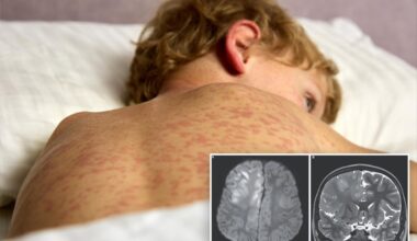 Boy, 7, dies of brain condition caused by measles — years later